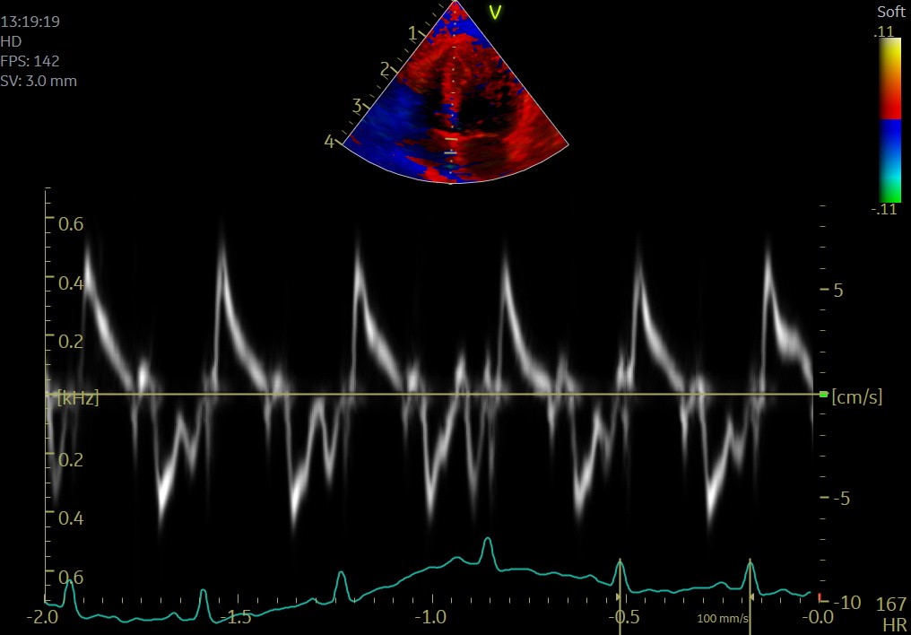 Post-systolic shortening is superior to global longitudinal strain