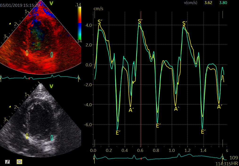 Post-systolic shortening is superior to global longitudinal strain