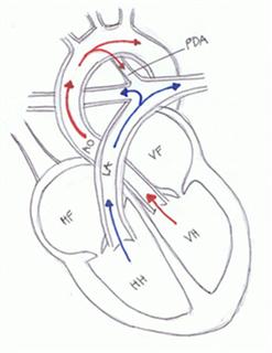 vækst Isolere igennem Persisterende Ductus Arteriosus – Københavns Universitet